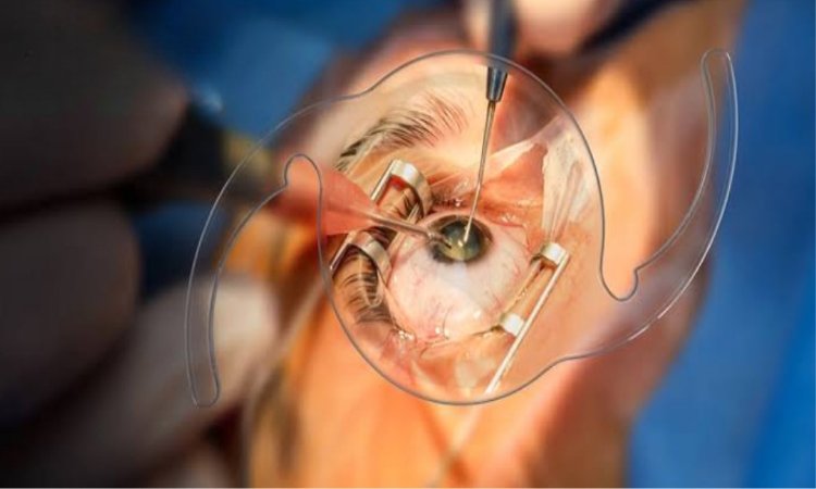 Prepare for Cataract Surgery