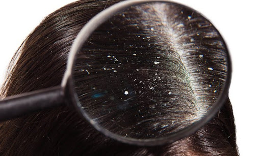 Best Dandruff Treatment Methods That Actually Work According to Experts