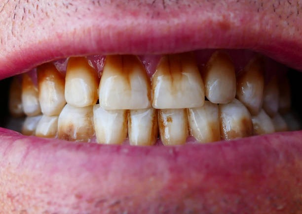 What Causes Teeth to Stain and How Can You Prevent It?