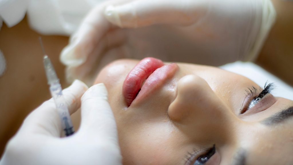 Elevate Your Beauty: Discover the Best Lip Filler in Sydney