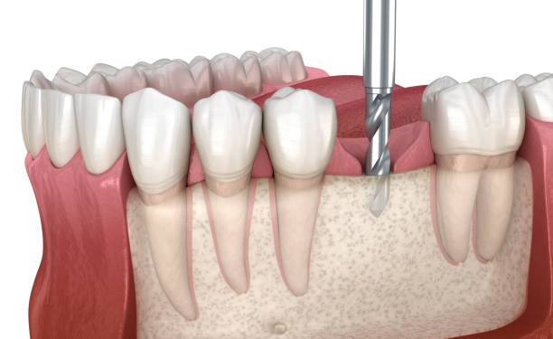 The Importance Of Surgical Precision In Implant Dentistry