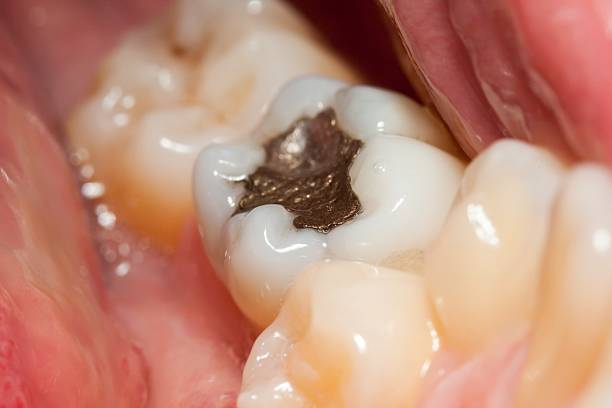 Some Kids Get More Cavities