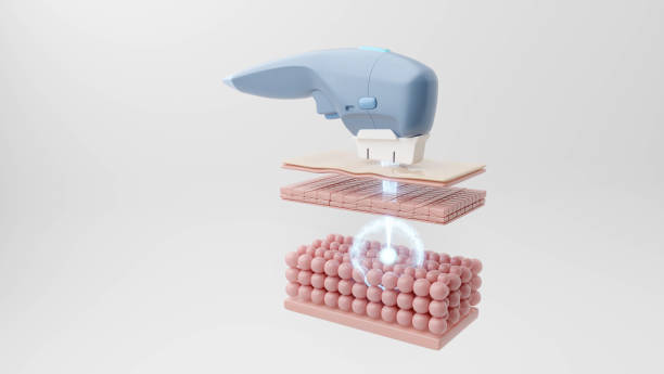 Revolutionize Your Look with HIFU Treatment: The Non-Surgical Facelift Solution