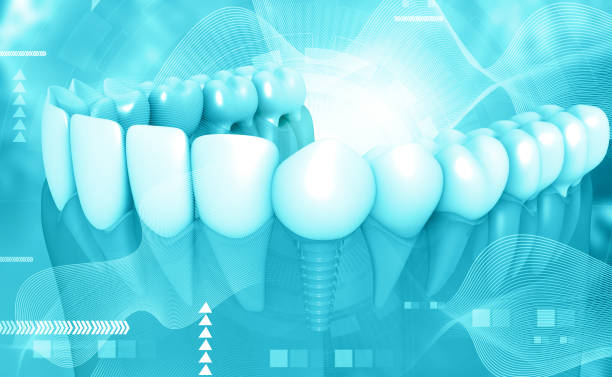 The Connection Between Gum Health And Successful Implant Placement